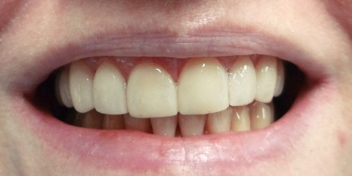 Sample after photo: the same smile after veneers (not a patient of this practice)